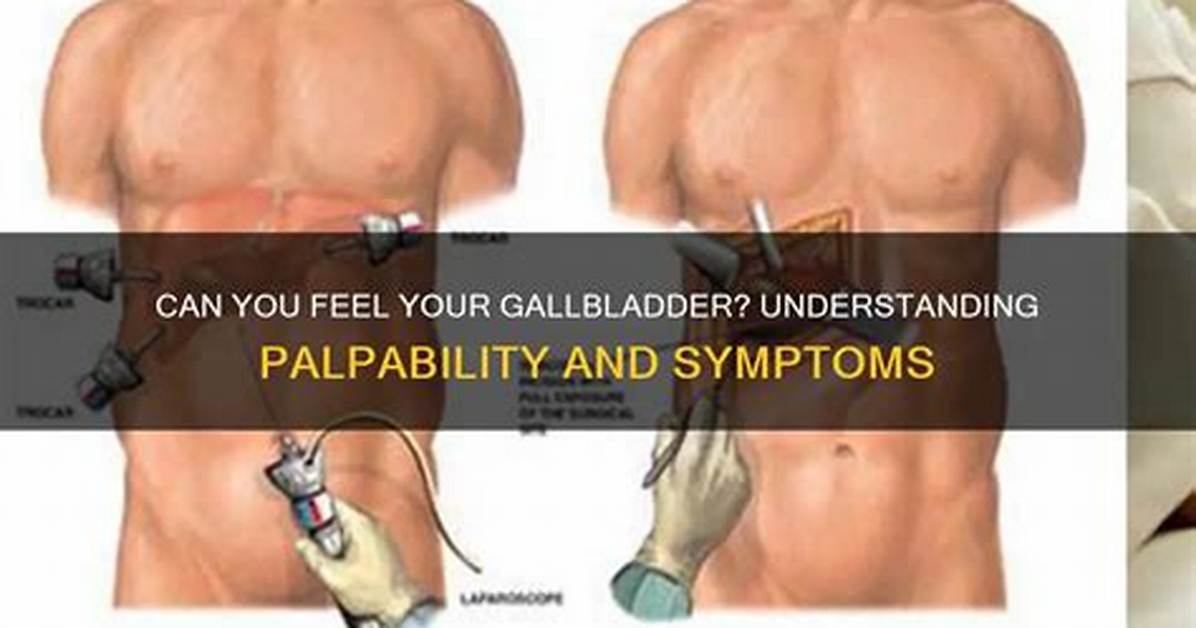 When Is Gallbladder Palpable?