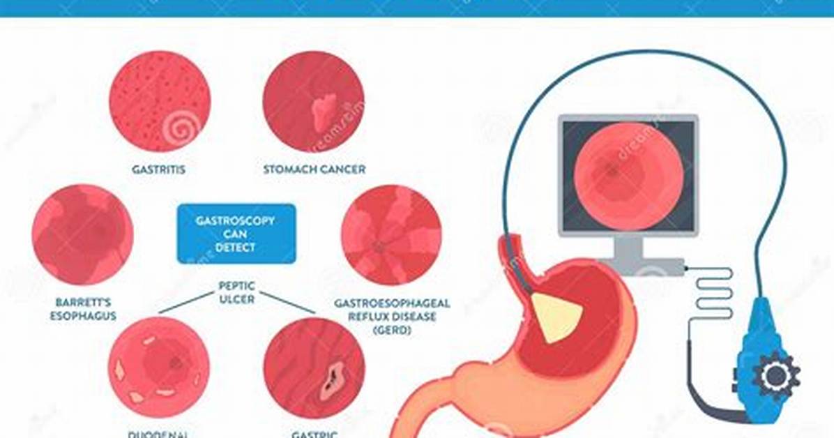 When Is Gastroscopy Needed?