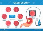 When Is Gastroscopy Needed?