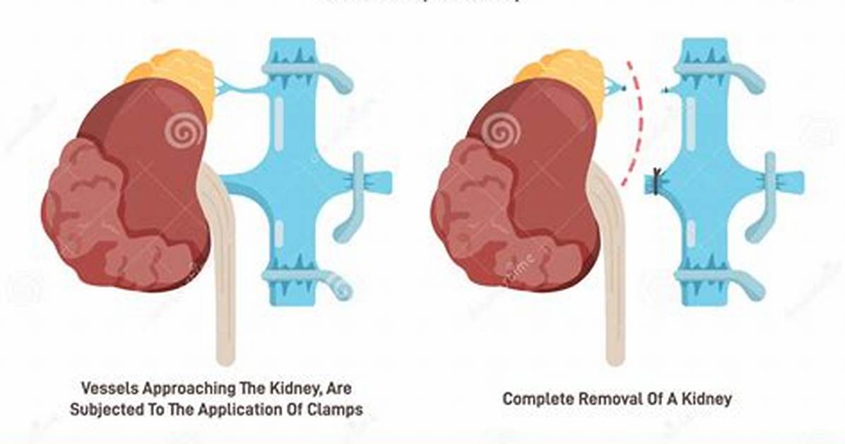 When Is Nephrectomy Necessary?