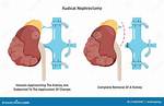 When Is Nephrectomy Necessary?