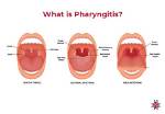 When Is Pharyngitis Not Contagious?