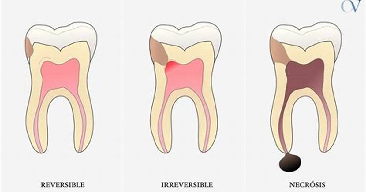 When Is Pulpitis Irreversible?