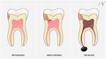 When Is Pulpitis Irreversible?