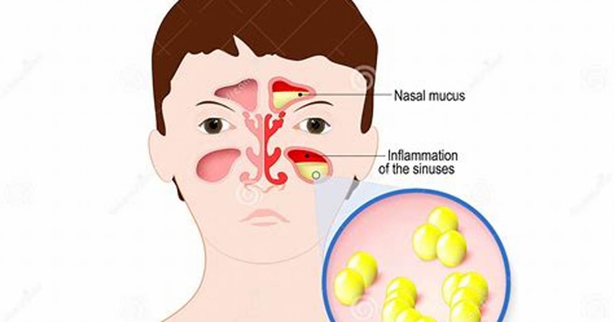 When Is Sinusitis Bacterial?