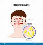 When Is Sinusitis Bacterial?