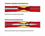 When Is Thrombectomy Indicated?