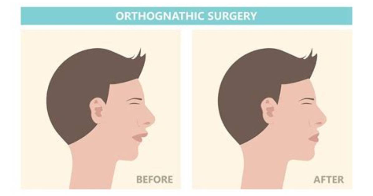 When Is Underbite Surgery Necessary?