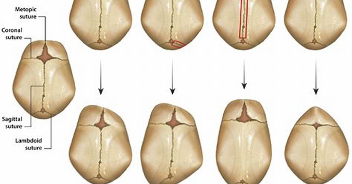 When Metopic Suture Closure?