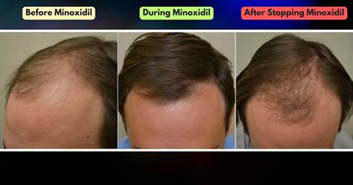 When Minoxidil Does Not Work?