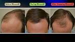 When Minoxidil Does Not Work?