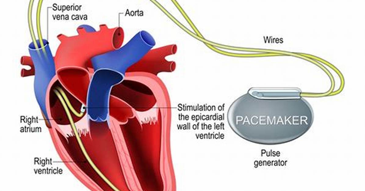 When Pacemaker Is Implanted in Heart?