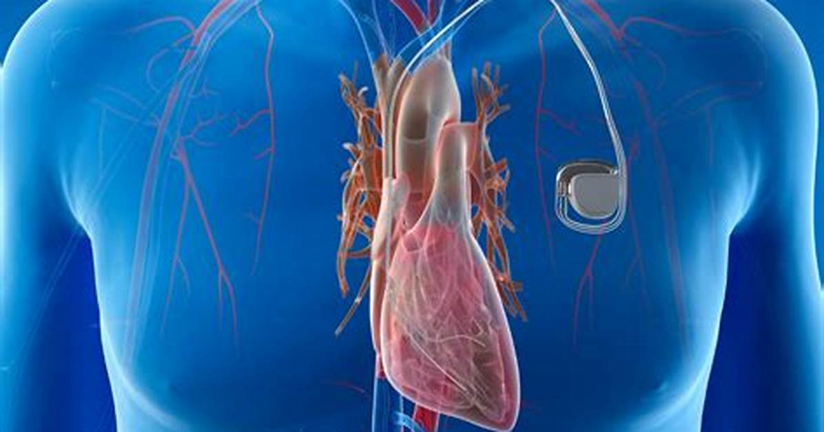 When Pacemaker Is Used?