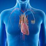 When Pacemaker Is Used?