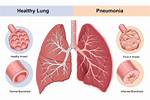 When Pneumonia Comes Back?
