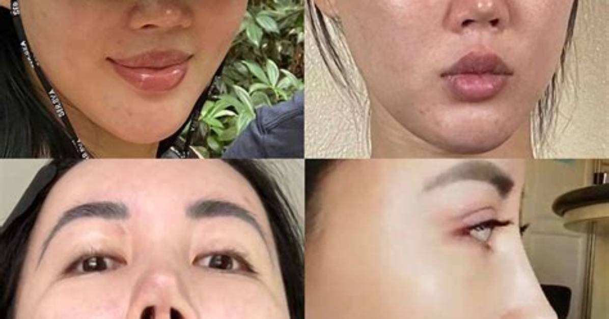 When Rhinoplasty Gone Wrong?