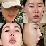 When Rhinoplasty Gone Wrong?