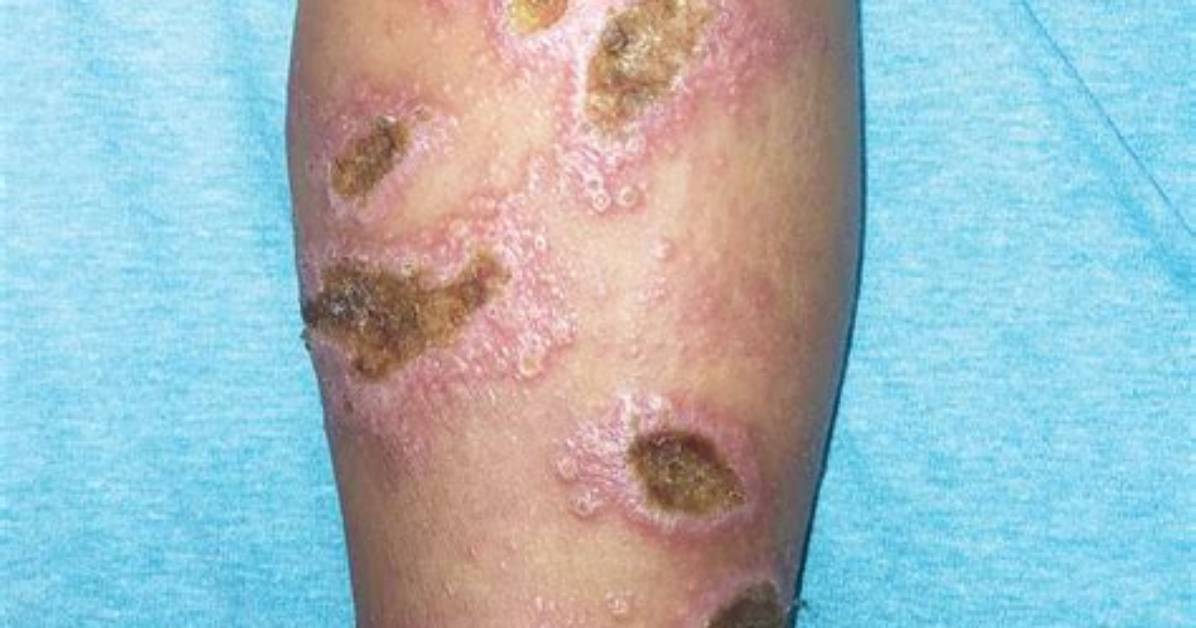 When Something Is Cutaneous?