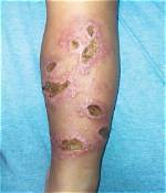 When Something Is Cutaneous?
