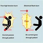 When Sustaining Electrical Burn?