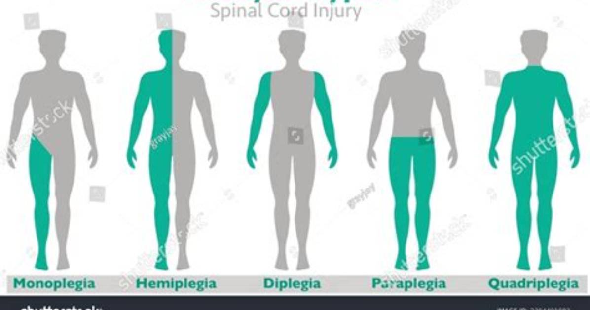 When to Code Hemiplegia?