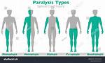 When to Code Hemiplegia?