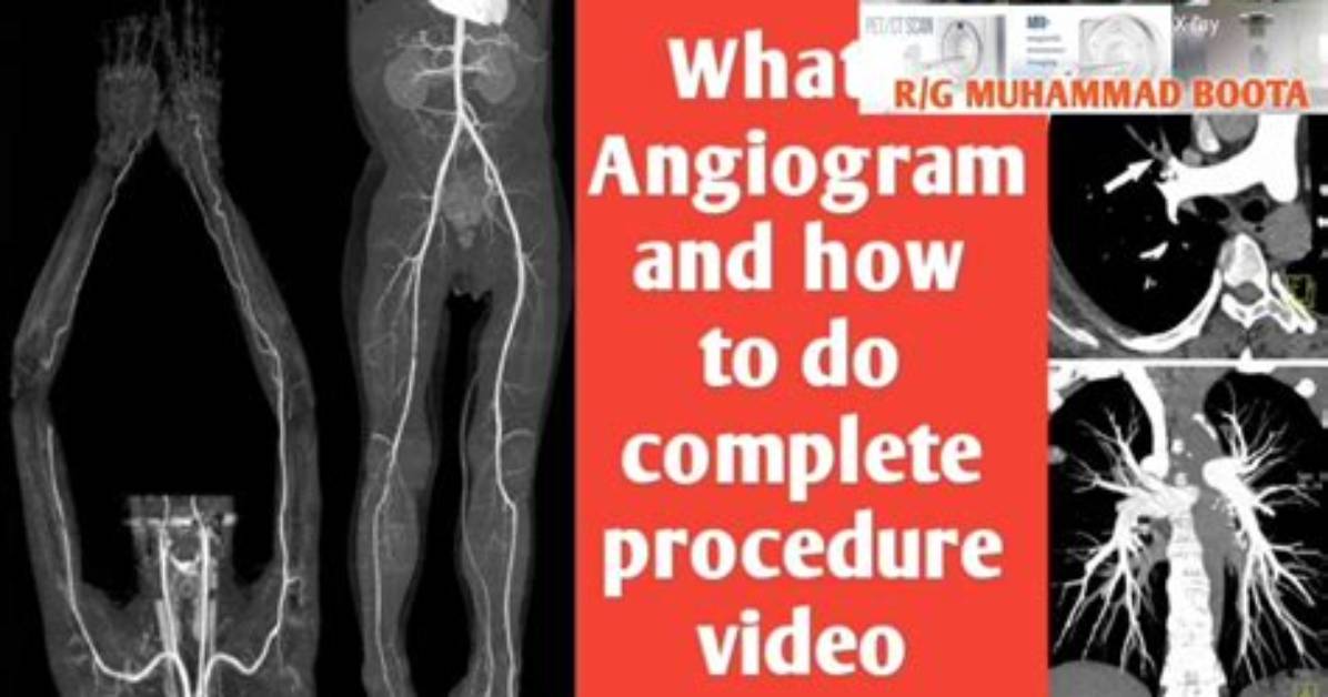 When to Do Arteriogram?