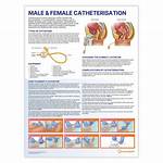 When to Do Catheterisation?