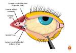 When to Do Lateral Canthotomy?