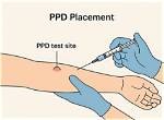 When to Do Ppd Test?
