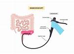When to Do Sigmoidoscopy?