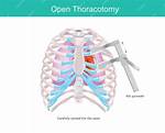 When to Do Thoracotomy?