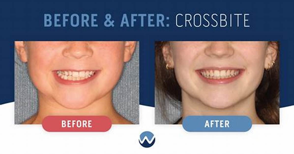 When to Fix a Crossbite?