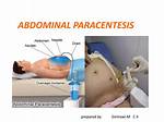 When to Get Paracentesis?