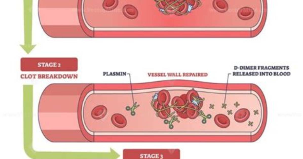 When to Test D Dimer?