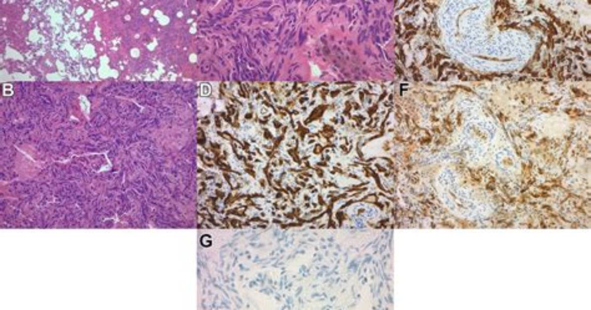 When Was Angiosarcoma Discovered?