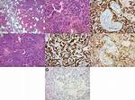 When Was Angiosarcoma Discovered?