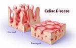 When Was Celiac Discovered?