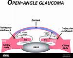When Was Glaucoma Discovered?