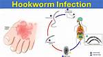When Was Hookworm Eradicated?