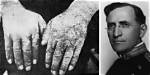When Was Pellagra First Discovered?