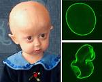 When Was Progeria Discovered?