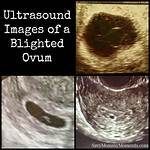 When Will Blighted Ovum Miscarry?