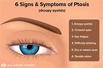 When Your Eye Droops?