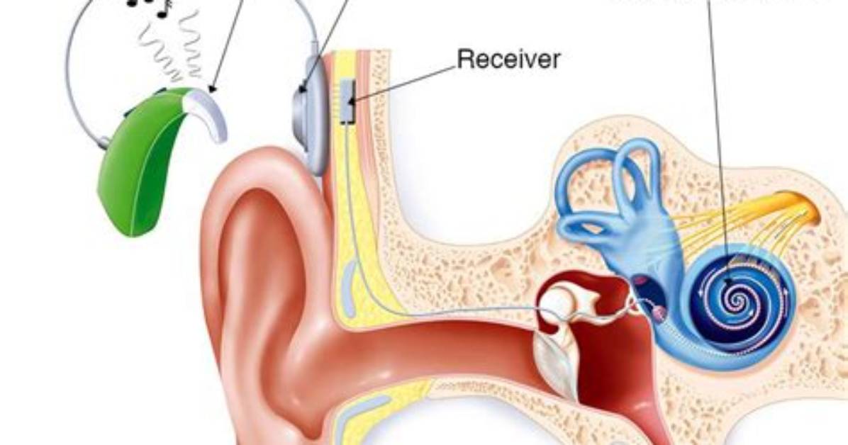 Where Are Cochlear Implants Surgically Inserted?