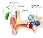 Where Are Cochlear Implants Surgically Inserted?