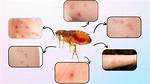 Where Are Flea Bites?
