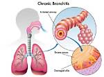 Where Bronchitis Come from?