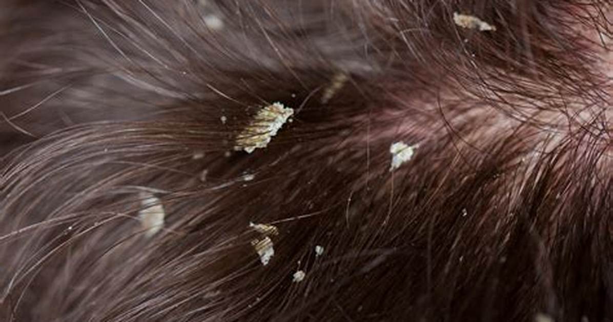 Where Dandruff Develops