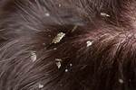 Where Dandruff Develops